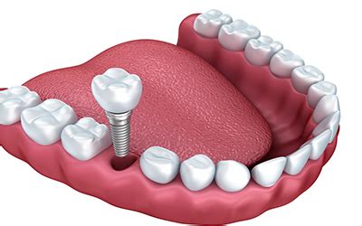 how much are fake screw in teeth